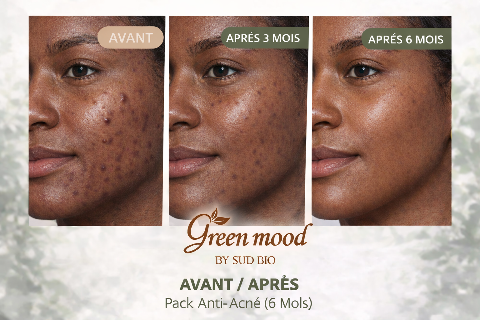 pack anti acne - avant apres